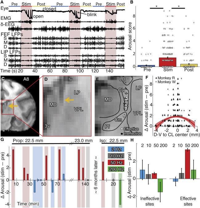 Изобрели мозговой имплантат, который поможет вытащить пациентов из комы
