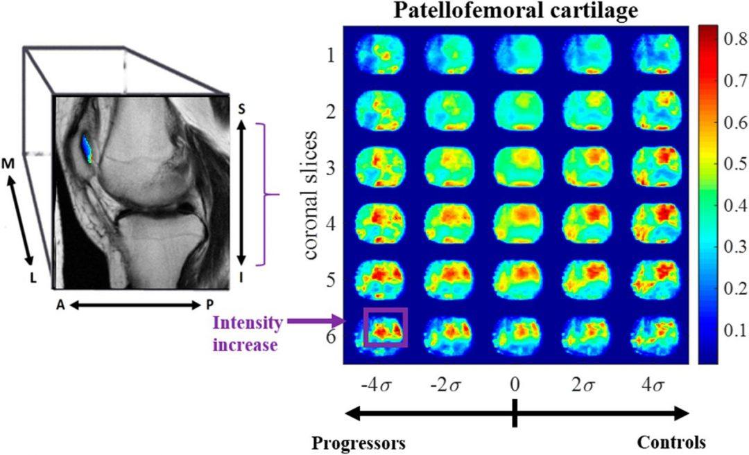 ИИ против раннего артрита