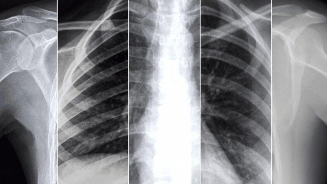 Новая ИИ-модель определяет, будут ли у пациента COVID-осложнения