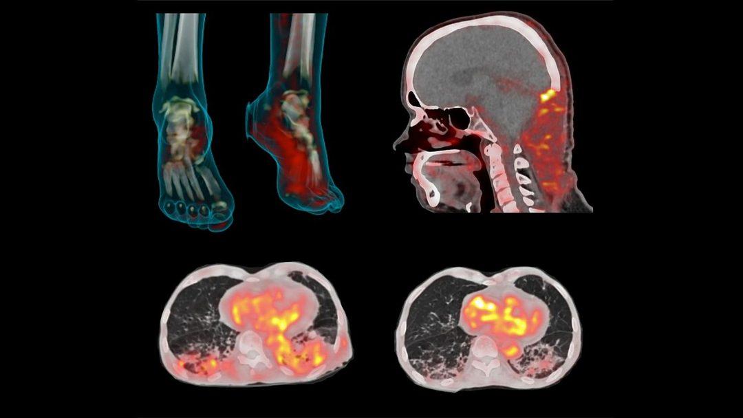 Научились находить инфекции с помощью сладенького