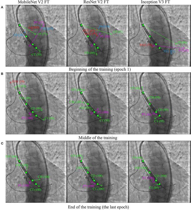 Новая российская нейросеть поможет хирургам устанавливать искусственный клапан в сердце