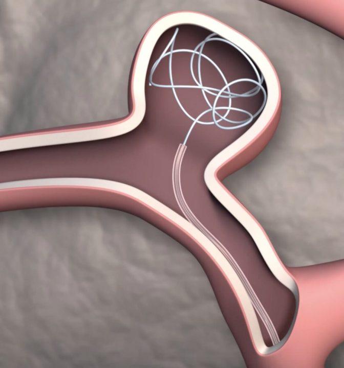 Изобрели управляемый катетер для нейрохирургических операций