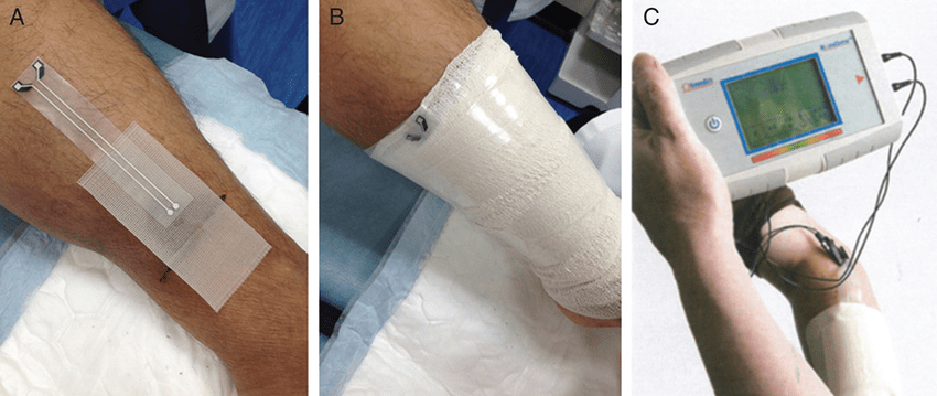 Умная повязка анализирует состояние раны и передаёт данные на смартфон