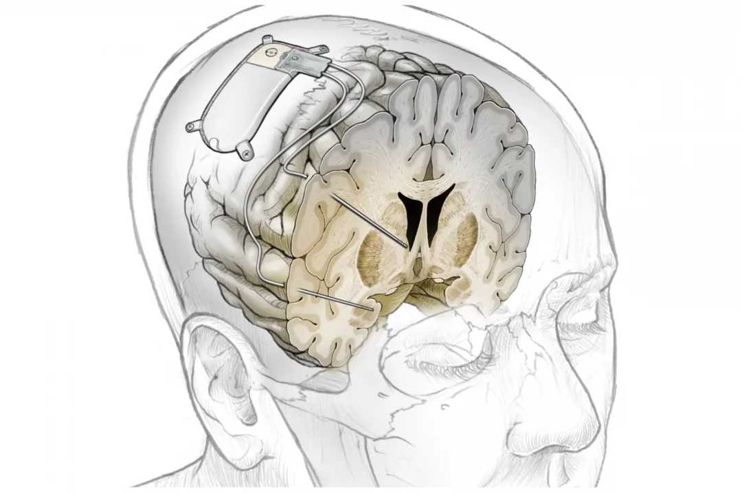 Новый мозговой имплантат лечит тяжёлую депрессию