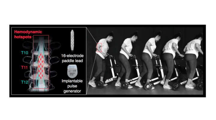 Создали имплантат, который лечит низкое артериальное давление у людей с травмой спинного мозга