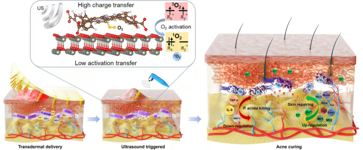 Изобрели пластырь с микроиглами, который с помощью ультразвука лечит акне