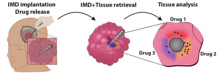 Создали устройство, которое вживляется в опухоль головного мозга во время операции и отслеживает воздействие лекарств